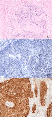 HPV Detection in Head and Neck Squamous Cell Carcinomas: What Is the Issue?